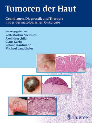 cover image of Tumoren der Haut